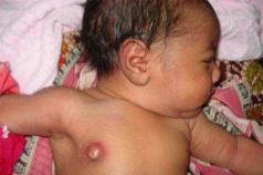 Уплотнение в грудной железе у детей У ребенка уплотнение груди