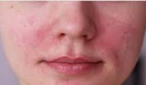 Купероз на лице: причины и лечение (100% гарантия излечения)
