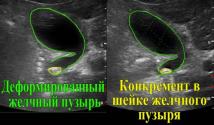 Mga indikasyon para sa ultrasound ng gallbladder Ultrasound ng gallbladder paghahanda para sa pagsusuri