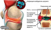 Serous rheumatoid arthritis