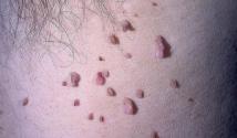 Malé papilómy na tele: príčiny a metódy liečby