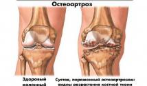 Príčiny, symptómy a liečba kĺbovej osteoartrózy