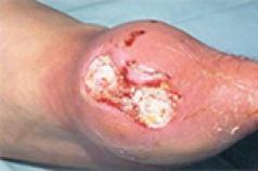 Gout: mga uri, sanhi, sintomas, diagnosis, paggamot